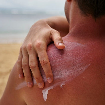 Pomada para quemaduras